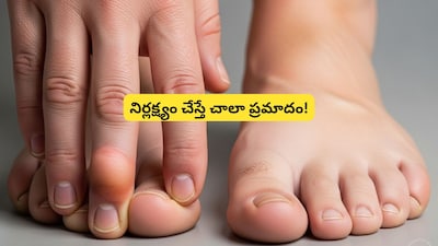 Swollen Hands & Feet? It Could Be a Sign of Kidney Trouble!