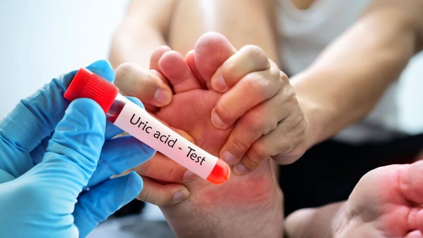 Uric Acid: వర్షాకాలం రాగానే చాలామందిలో యూరిక్ యాసిడ్ స్థాయిలు పెరిగి కీళ్ల నొప్పులు, కాళ్ల వాపులు, తీవ్రమైన మోకాళ్ల నొప్పులు వేధిస్తుంటాయి. వర్షాకాలంలో తక్కువ నీరు తాగడం, శారీరక శ్రమ తగ్గడం, కాలుష్యం వల్ల కీళ్లలో ప్యూరిన్ స్ఫటికాలు పేరుకుపోయి రక్తంలో యూరిక్ యాసిడ్ వేగంగా పెరుగుతుంది. సరైన జీవనశైలి మార్పులు చేసుకోకపోతే ఇవి భవిష్యత్తులో కిడ్నీలో రాళ్లు ఏర్పడటానికి కారణమవుతాయి.