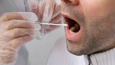 Oral Cancer: Early Signs to Watch For as Cases Rise, Even Under 50