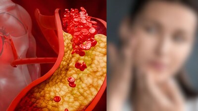 उच्च कोलेस्ट्रॉल: चेहऱ्यावरील हे बदल धोक्याची घंटा! डोळे आणि पायांकडे लक्ष द्या