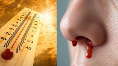 उन्हाळ्यात नाकातून रक्त का येते? कारणे आणि थांबवण्यासाठी सोपे उपाय