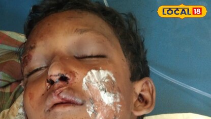 కన్నకొడుకును ముఖంనిండా వేడివేడి అట్లకాడతో వాతలు పెట్టిన తండ్రి