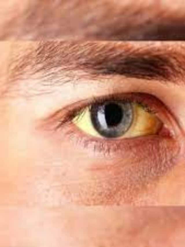 5 Juices Every Jaundice Patient Should Have