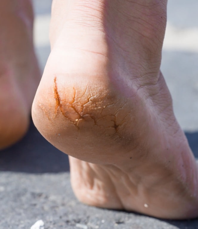 How To Heal Cracked Heels?