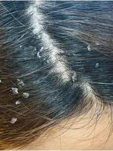 5 essential hair oils to treat dandruff in winter