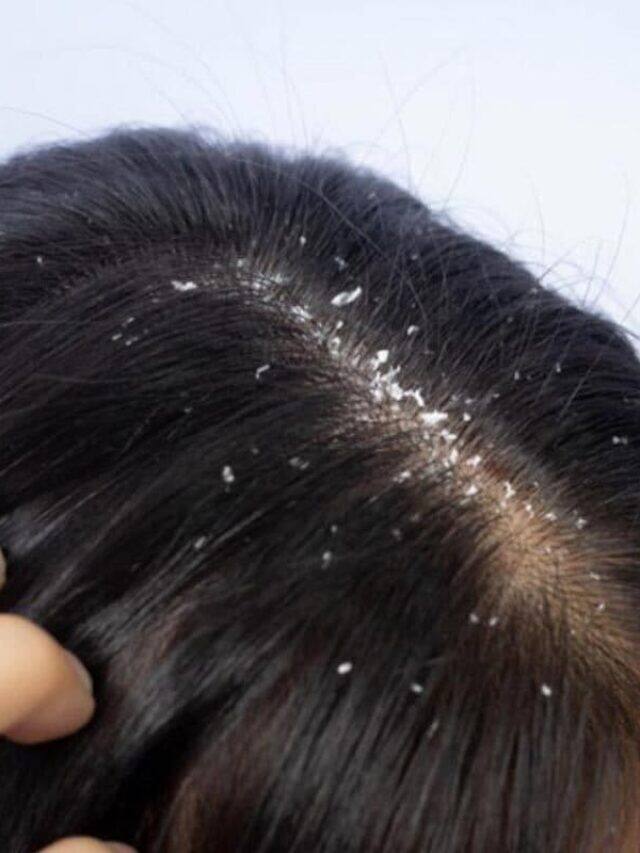 5 Ways To Use Camphor To Get Rid Of Dandruff