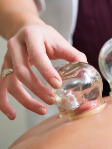 Is cupping therapy good? It has benefits, but only if done right