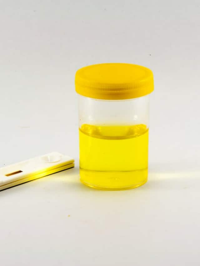 પેશાબનો રંગ પીળો થઇ જાય તો ચેતજો, આ ગંભીર છે સંકેત