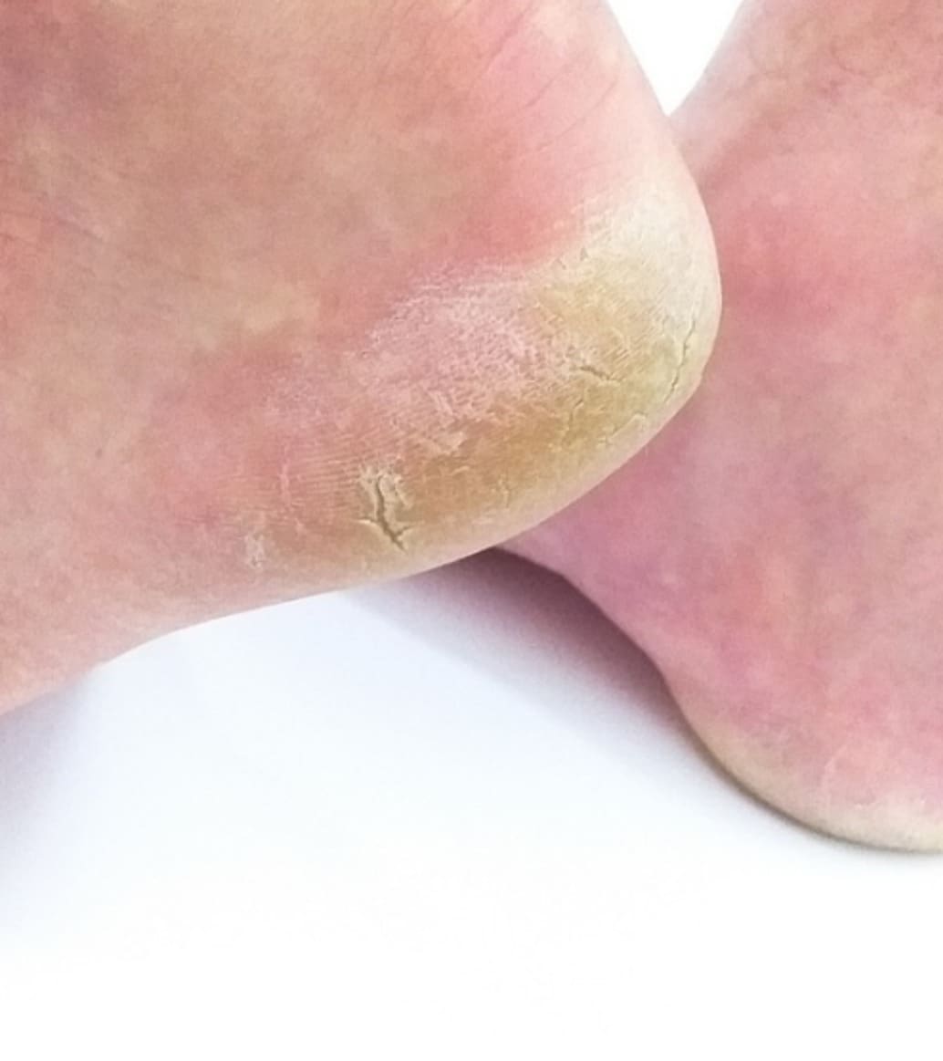 Cracked Heels Treatment and Management - Foot And Ankle