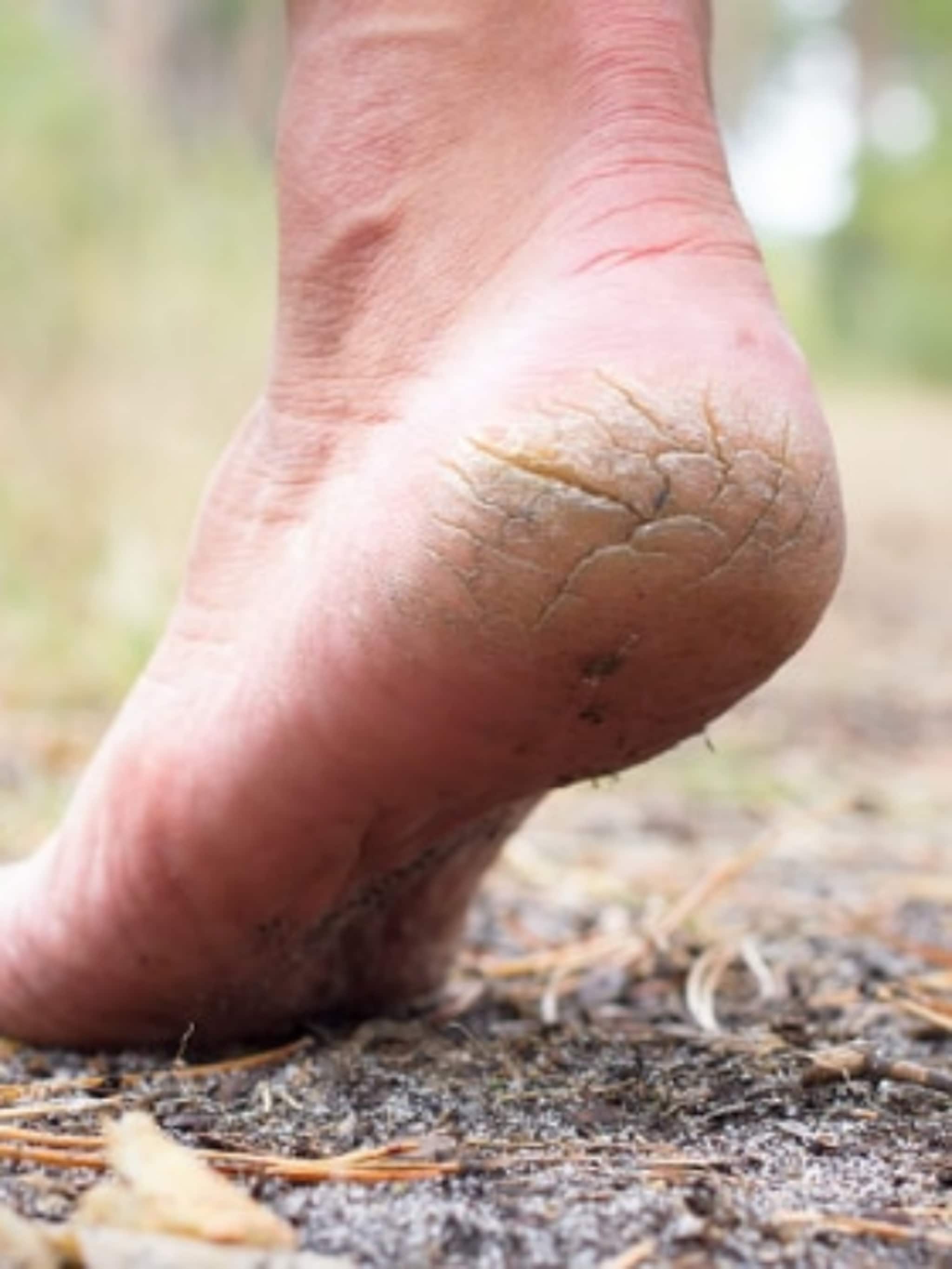 हिवाळ्यात टाचांना भेगा पडतायंत? करा हे 3 उपाय!