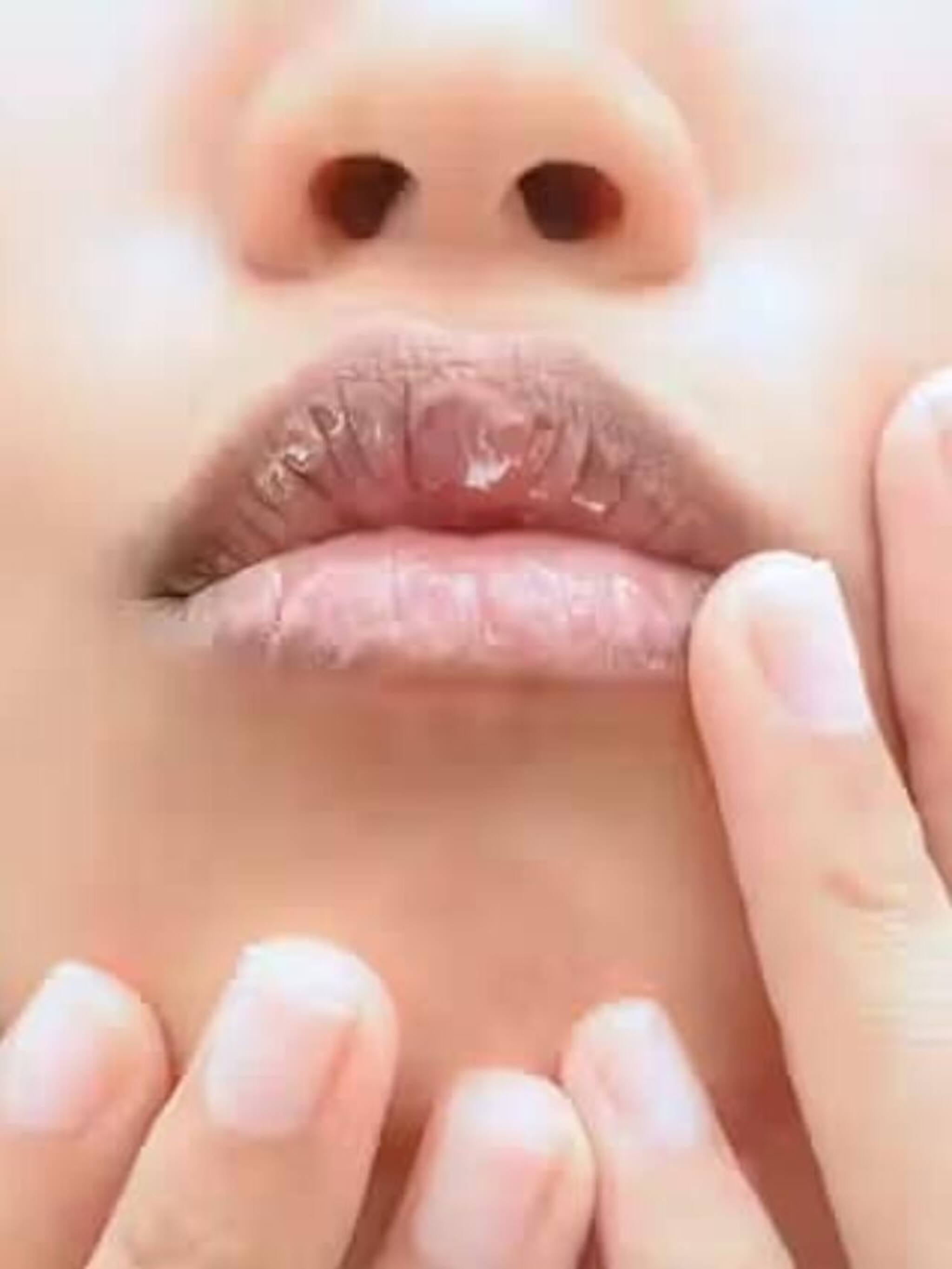 हिवाळ्यात ओठ का फाटतात?