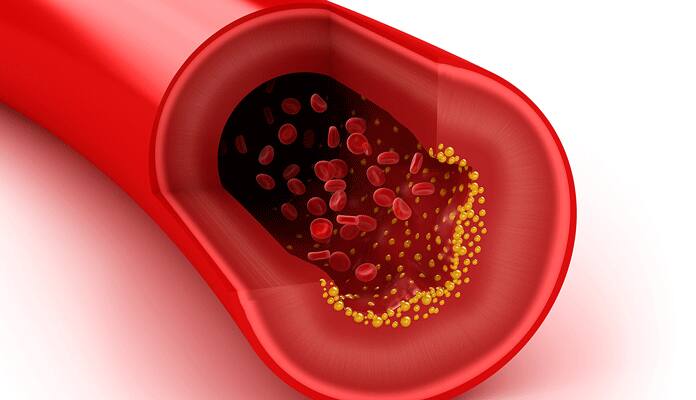 high-cholesterol