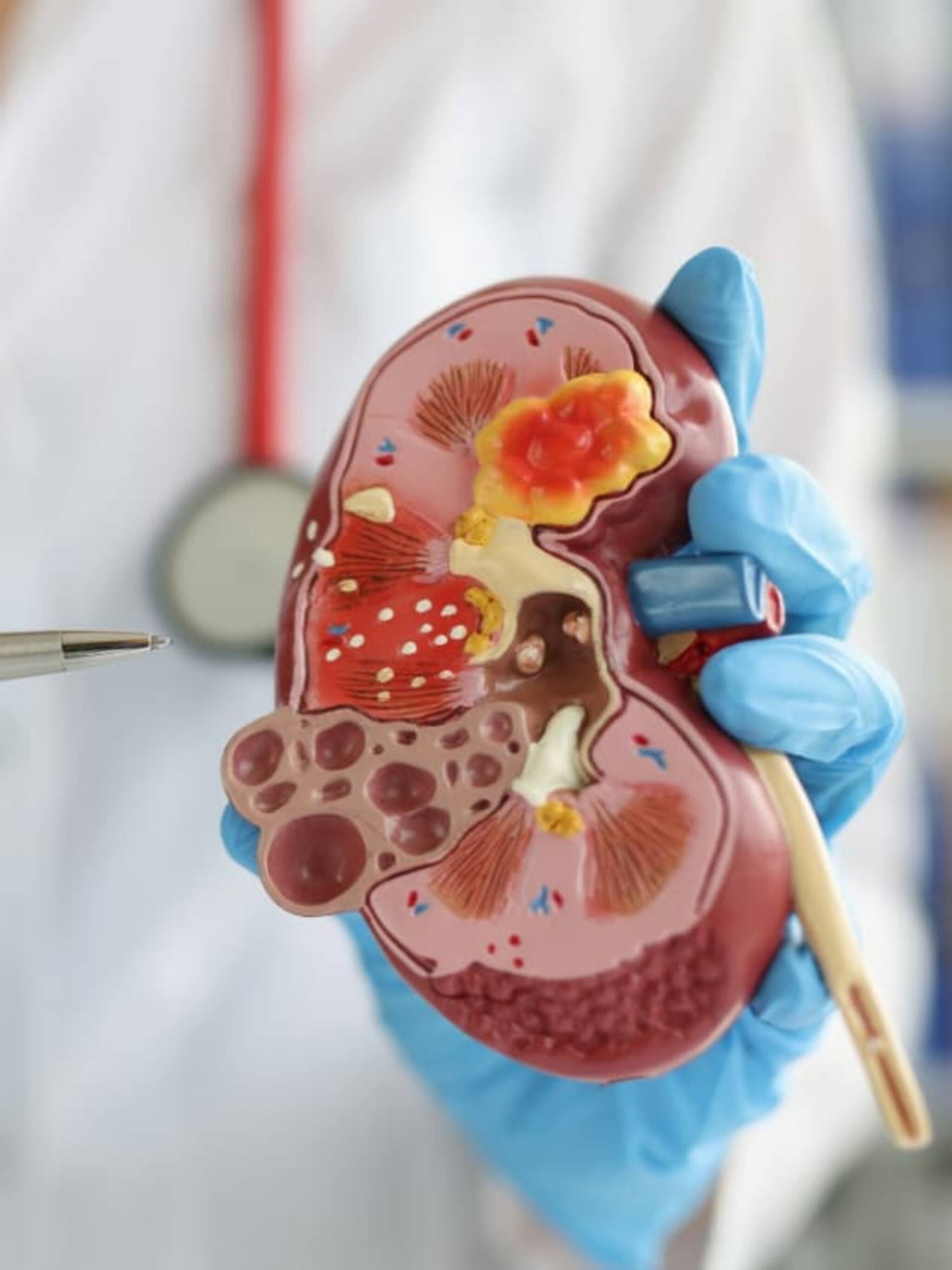 किडनी स्टोन का तयार होतात? वाचा 6 महत्त्वाची कारणं!