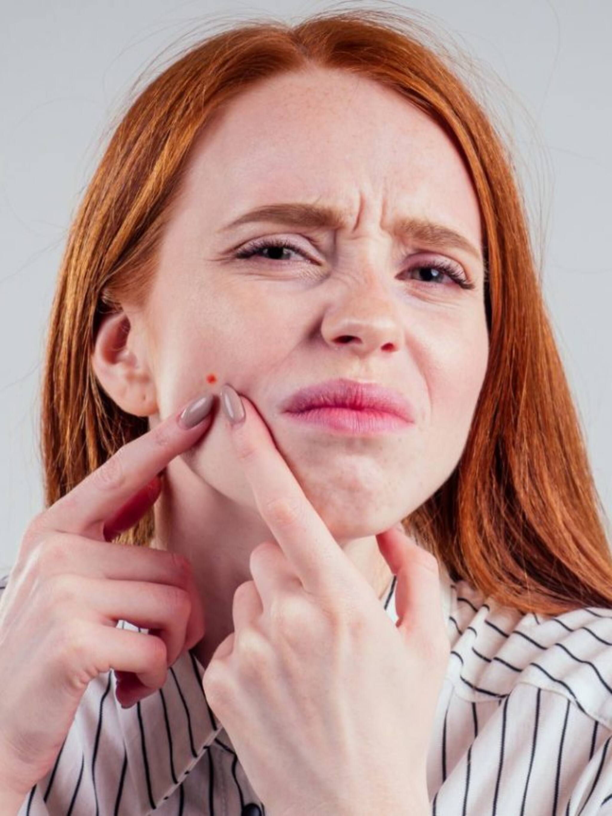 मासिकपाळी आधी आणि नंतर पिंपल्स का येतात?