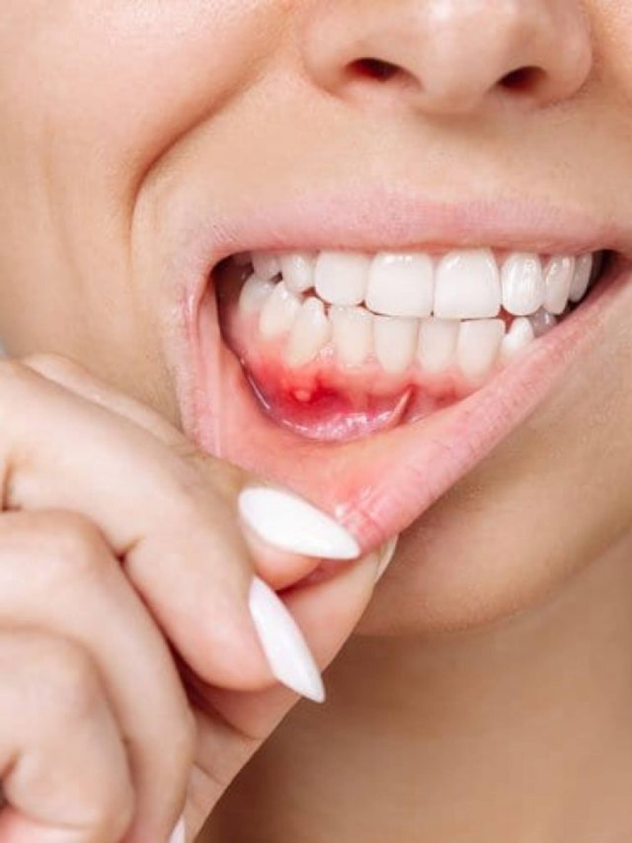 तोंडात फोड आलेत, वेदना असह्य झाल्यात? या उपायांनी मिळेल आराम