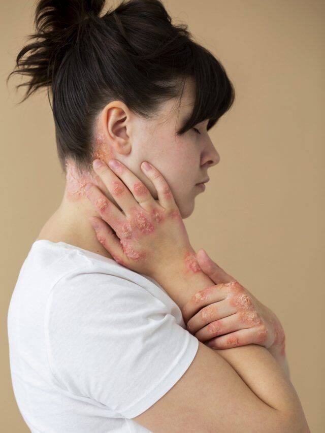 Heat Rash Shower Oatmeal bath to cold compress: 10 ways to treat heat rash