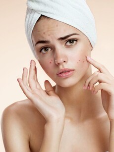 8 expert-approved home remedies to get rid of acne scars