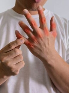 Diet tips to prevent kidney stones, lower uric acid levels