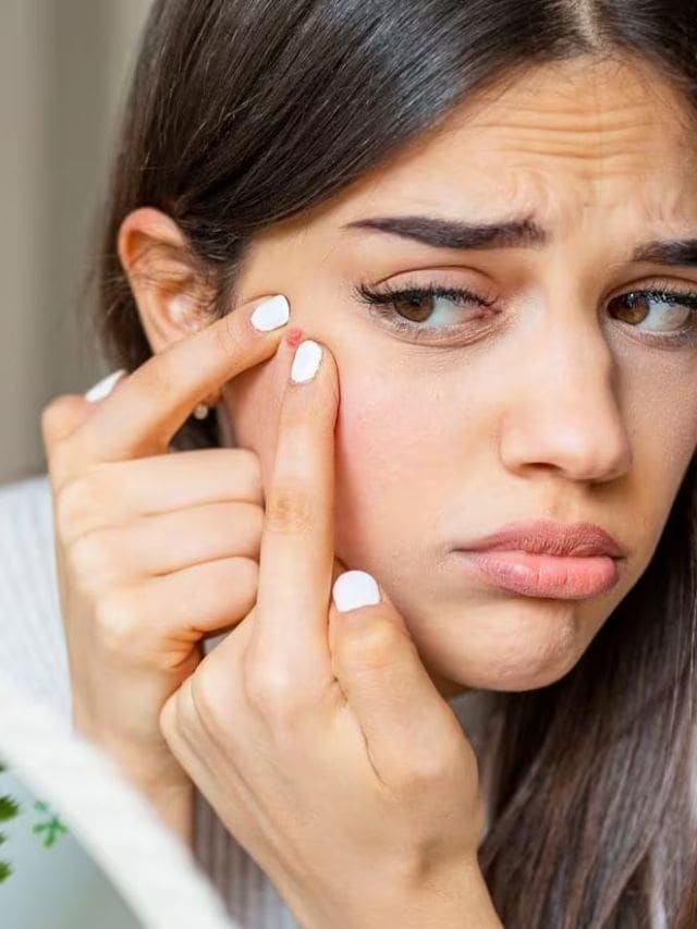 5 Home Remedies To Get Rid Of Acne