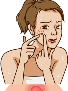 Stress, poor diet, more: 10 reasons acne isn’t just a cosmetic issue