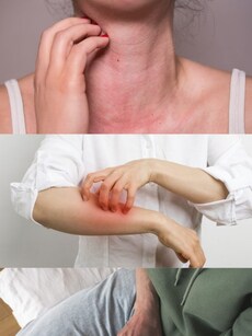 Skin allergies: Avoid these 10 triggers to keep skin healthy