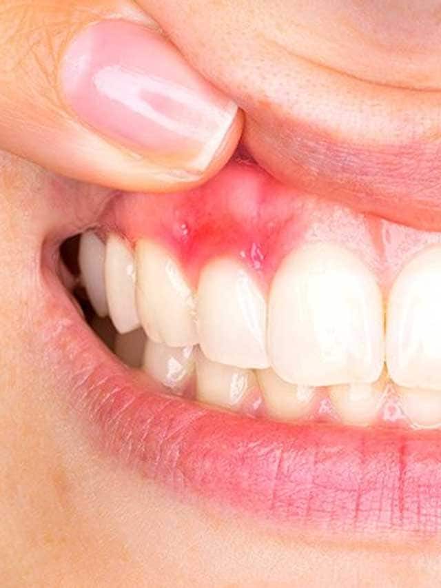 7 Signs Of Vitamin Deficiency You Should Not Ignore