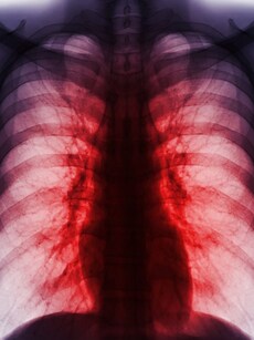 World Tuberculosis Day 2025: 10 tips to prevent tuberculosis