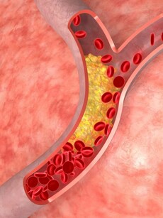 10 causes of high cholesterol: Obesity, smoking, ageing, more