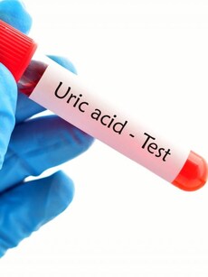 5 symptoms of high uric acid; Don’t ignore fatigue, joint pain