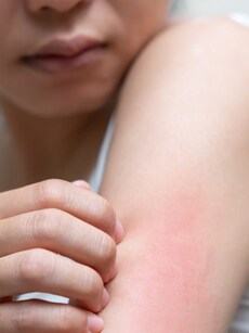 Fungal Infections: Risks, Symptoms,  and Proper Care