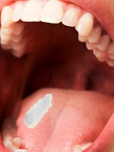 Know More About Leukoplakia: A Malignant Oral Cavity