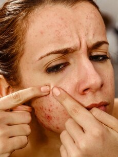 Struggling with Acne? Here’s What Actually Works & What Doesn’t
