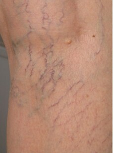 10 everyday risks that slowly raise your chances of blood clots