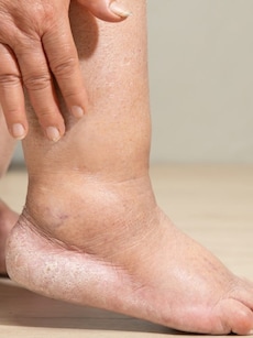 What Is Edema? Symptoms, Causes & Associated Conditions