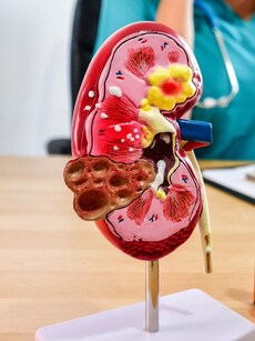 Prevent kidney cancers with these 10 easy, healthy habits