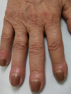 Health tips: 10 reasons you should take nail clubbing seriously