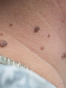 10 Ways To Manage And Treat Stubborn Warts Effectively