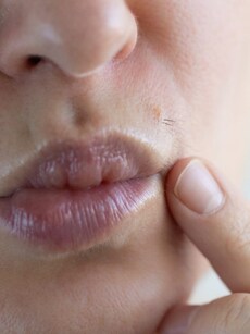 What is Hirsutism: 10 Causes and Associated Factors