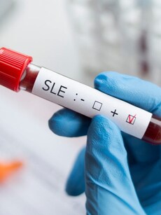 10 things about lupus nephritis: Kidney damage in lupus