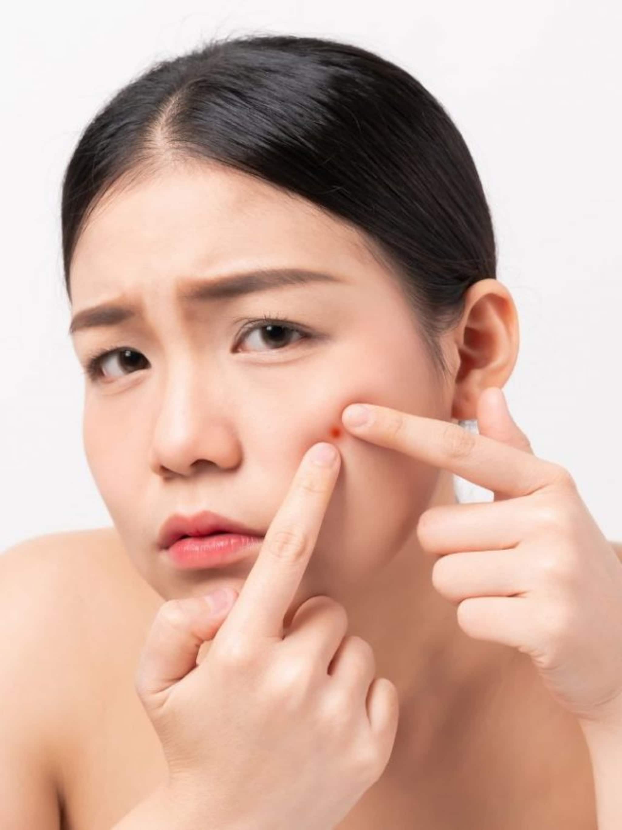 थूंकी लावल्याने खरंच पिंपल्स जातात? काय सांगतात तज्ज्ञ