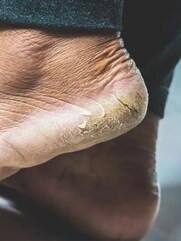 মধু, কলার মতো ঘরোয়া টোটকায় পান নরম, তুলতুলে গোড়ালি